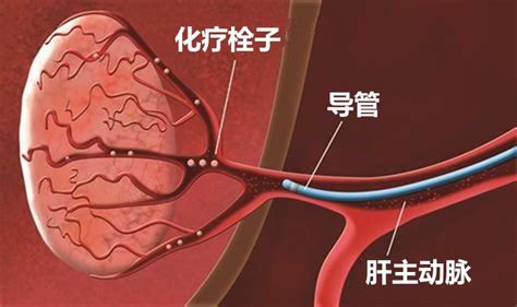 球缺,求它的一些公式