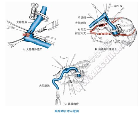 心脏端端吻合器是什么,谁将是下一个蓝海市场