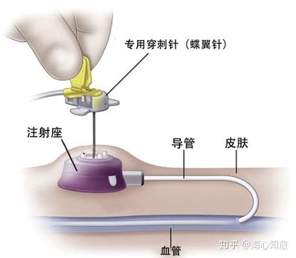 细血管静脉穿刺的技巧,静脉穿刺如何固定血管