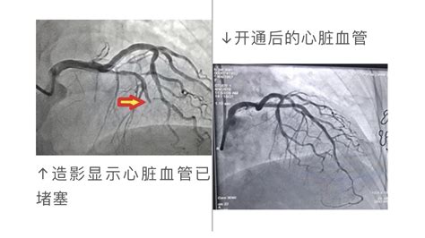 急性心肌梗死的临床表现,发生急性心肌梗死的首要护理是什么