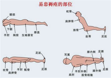 如何避免压疮,怎么预防压疮