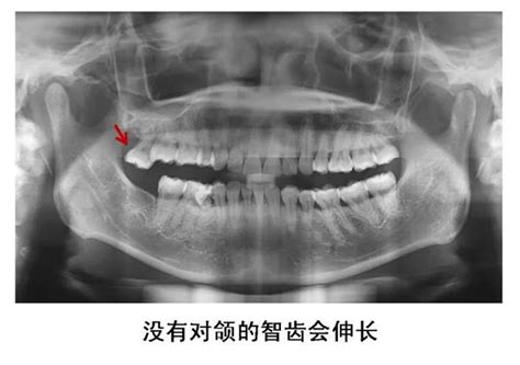 长智齿的前兆是什么,智齿科技