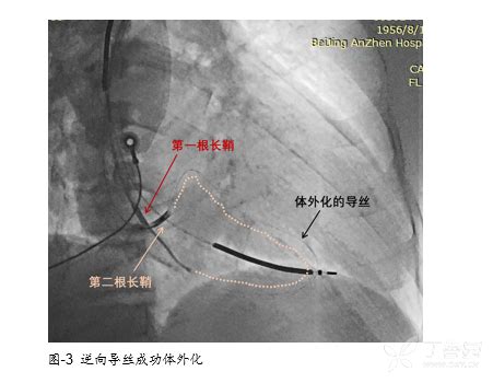 如何做好慢病管理,慢病管理如何写